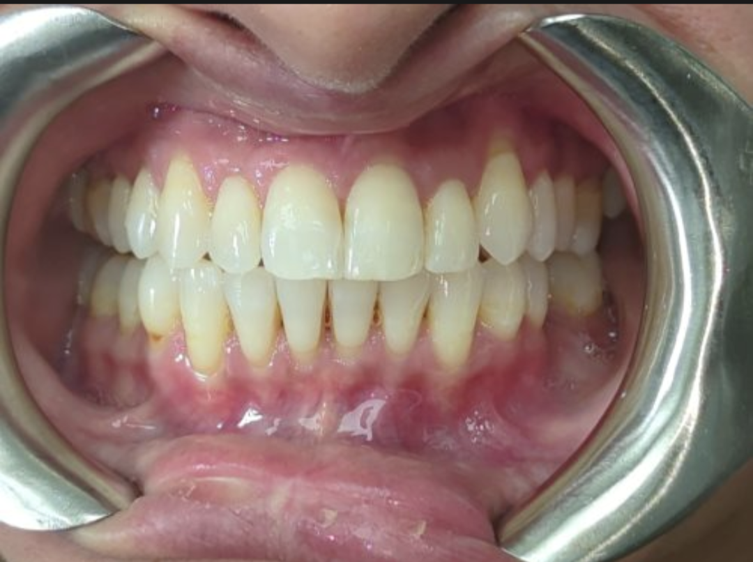 The same patient's smile after Invisalign treatment