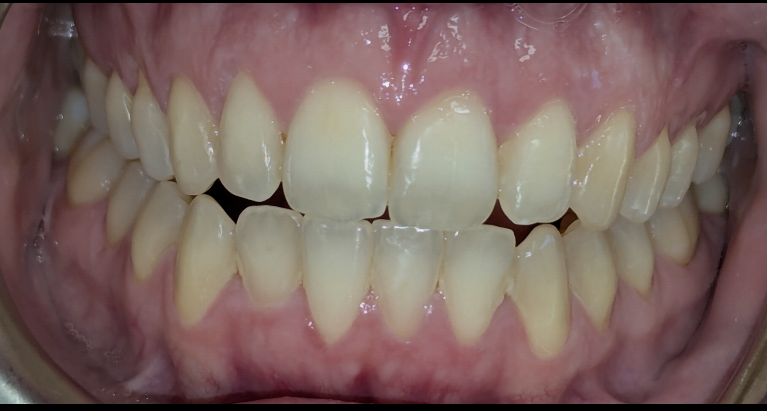 The same patient's smile after Invisalign treatment