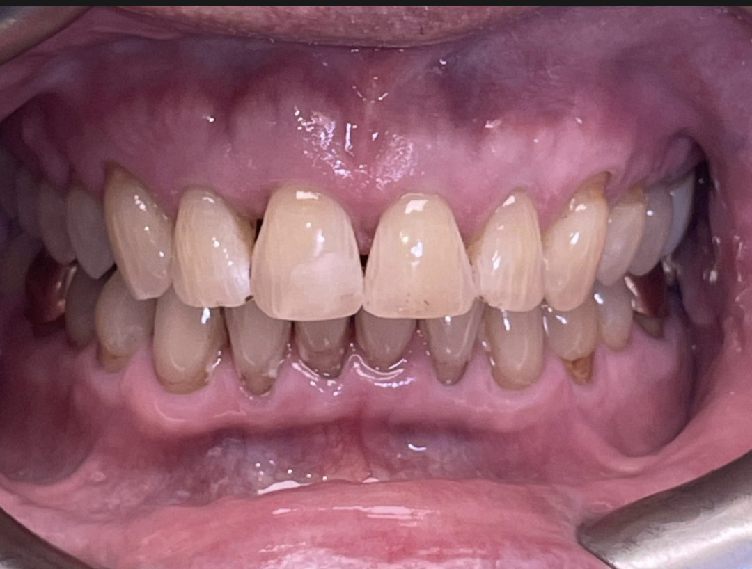 The same patient's smile after Invisalign treatment