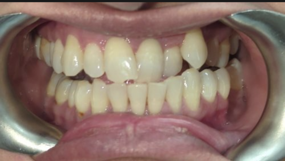 Patient smile before Invisalign treatment at Pearl Dental Group