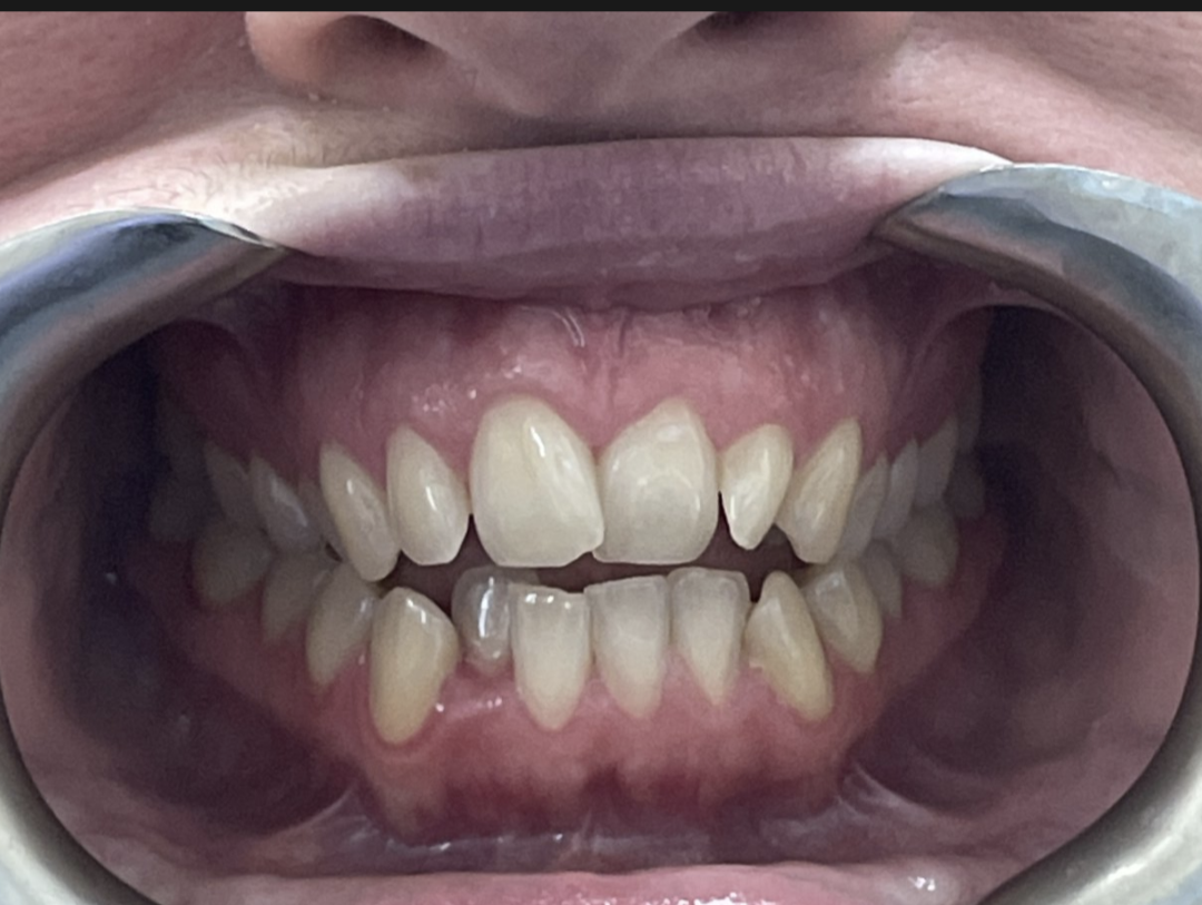 Patient smile before Invisalign treatment at Pearl Dental Group