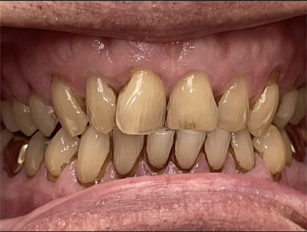 Patient smile before Invisalign treatment at Pearl Dental Group