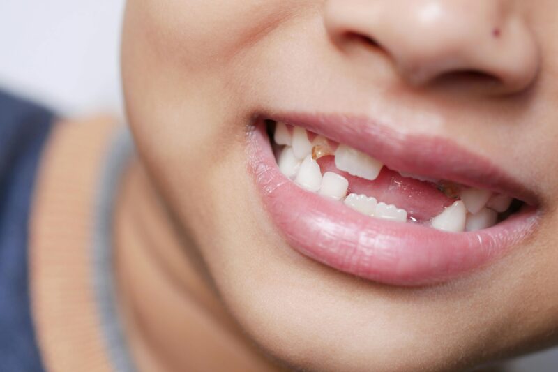 child with missing baby teeth